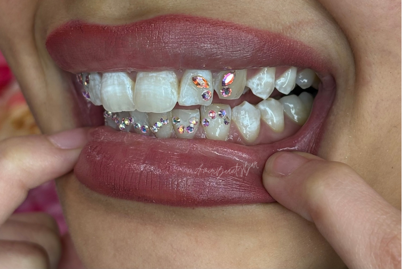 2026 Tooth Gem Trends: From Butterfly Sets to 22K Gold Charms